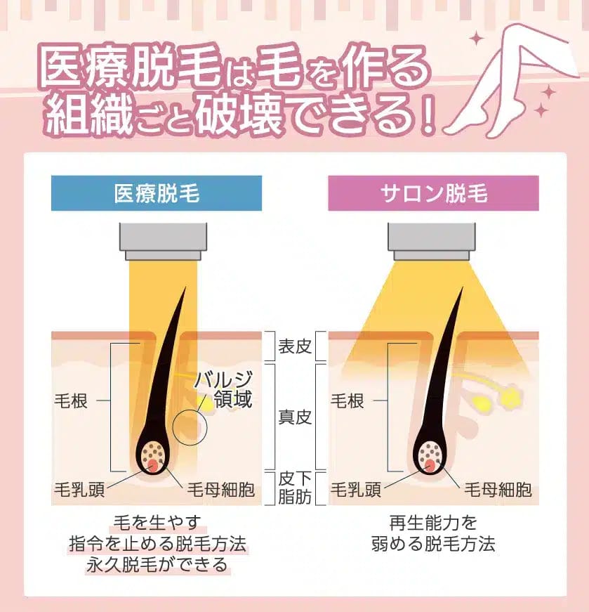 医療脱毛が永久脱毛できる仕組み